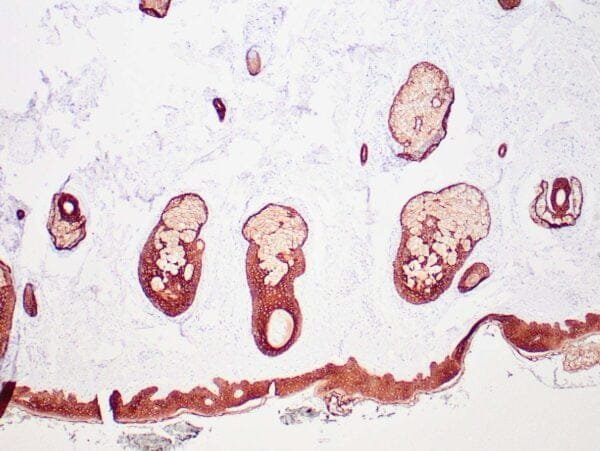 Immunohistochemistry (IHC) : Human skin with carcinoma stained with anti-HMW, CK antibody using peroxidase-conjugate and DAB chromogen. Note membrane and cytoplasmic staining of squamous epithelium.