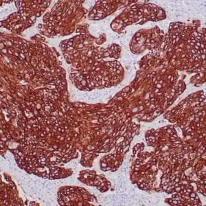 Immunohistochemistry (IHC) : Human infiltrating breast carcinoma stained with anti-pankeratin AE1/AE3 antibody using peroxidase-conjugate and DAB chromogen. Note the cytoplasmic staining of tumor cells.