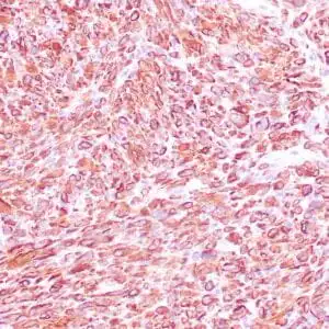 Immunohistochemistry (IHC) : Human uterus stained with anti-desmin antibody using peroxidase-conjugate and DAB chromogen. Note the cytoplasmic staining of smooth muscle cells.