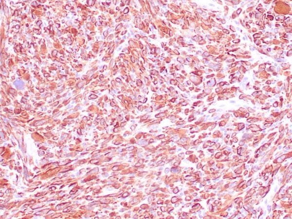 Immunohistochemistry (IHC) : Human uterus stained with anti-desmin antibody using peroxidase-conjugate and DAB chromogen. Note the cytoplasmic staining of smooth muscle cells.