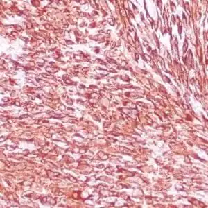 Immunohistochemistry (IHC) : Human leiomyosarcoma stained with anti-desmin antibody using peroxidase-conjugate and DAB chromogen. Note the cytoplasmic staining of tumor cells.