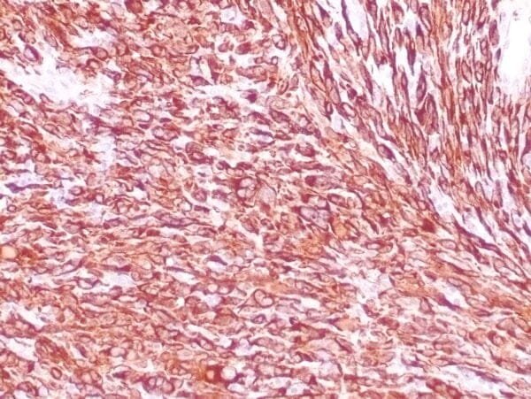 Immunohistochemistry (IHC) : Human leiomyosarcoma stained with anti-desmin antibody using peroxidase-conjugate and DAB chromogen. Note the cytoplasmic staining of tumor cells.