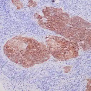 Immunohistochemistry (IHC) : Formalin-fixed, paraffin-embedded human squamous cell carcinoma stained with anti-desmoglein-3 monoclonal antibody using peroxidase-conjugate and DAB chromogen. Note membranous staining of tumor cells