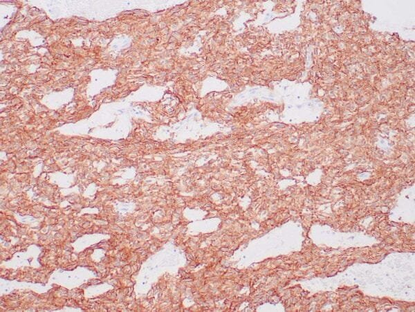 Immunohistochemistry (IHC) : GIST stained with DOG-1 antibody using peroxidase-conjugate and DAB chromogen. Note the strong cytoplasmic staining of tumor cells.