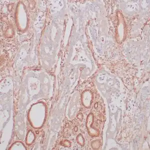 Immunohistochemistry (IHC) : Formalin-fixed human pancreatic ductal carcinoma stained with anti-DPC4 antibody using peroxidase-conjugate and DAB chromogen. Note the nuclear and cytoplasmic staining of normal pancreatic tissue, whereas ductal carcinoma glands are negative
