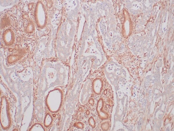 Immunohistochemistry (IHC) : Formalin-fixed human pancreatic ductal carcinoma stained with anti-DPC4 antibody using peroxidase-conjugate and DAB chromogen. Note the nuclear and cytoplasmic staining of normal pancreatic tissue, whereas ductal carcinoma glands are negative