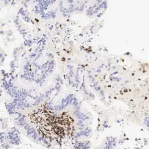 Immunohistochemistry (IHC) : Human pancreatic ductal adenocarcinoma stained with anti-DPC4 (SMAD4) antibody using peroxidase-conjugate and DAB chromogen. Note absence of tumor cell staining while the non-tumor cells are positive.
