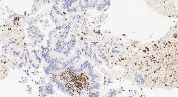 Immunohistochemistry (IHC) : Human pancreatic ductal adenocarcinoma stained with anti-DPC4 (SMAD4) antibody using peroxidase-conjugate and DAB chromogen. Note absence of tumor cell staining while the non-tumor cells are positive.