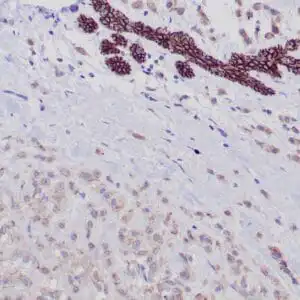 Immunohistochemistry (IHC) : Formalin-fixed paraffin-embedded human breast lobular anti-E-Cadherin antibody using peroxidase-conjugate and DAB chromogen. Note the strong membranous staining of ductal cells (top), whereas tumor cells show weak cytoplasmic staining.
