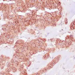 Immunohistochemistry (IHC) : Human infiltrating breast carcinoma stained with anti-E-cadherin antibody using peroxidase-conjugate and DAB chromogen. Note the membrane staining of carcinoma cells.