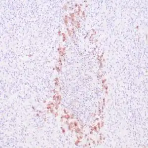 Immunohistochemistry (IHC) : Human Hodgkin’s lymphoma stained with anti-EBV-LMP antibody using peroxidase-conjugate and DAB chromogen. Note intense cytoplasmic staining of Reed-Sternberg cells.