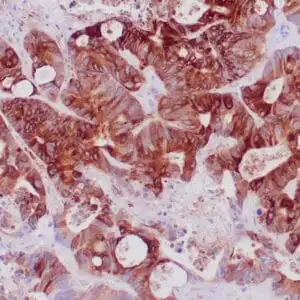 Immunohistochemistry (IHC) : Formalin-fixed, paraffin-embedded human colon cancer stained with anti-EMA antibody using peroxidase-conjugate and DAB chromogen. Note the membrane and cytoplasmic staining of tumor cells
