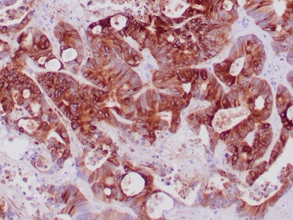 Immunohistochemistry (IHC) : Formalin-fixed, paraffin-embedded human colon cancer stained with anti-EMA antibody using peroxidase-conjugate and DAB chromogen. Note the membrane and cytoplasmic staining of tumor cells