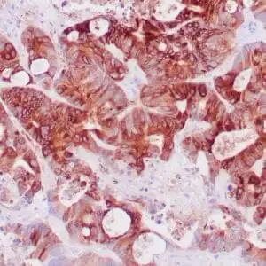 Immunohistochemistry (IHC) : Human breast cancer stained with anti-EMA antibody using peroxidase-conjugate and DAB chromogen. Note the membrane and cytoplasmic staining of tumor cells.