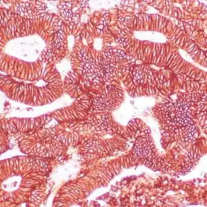 Immunohistochemistry (IHC) : Human colon adenocarcinoma stained with EP-CAM antibody using peroxidase-conjugate and DAB chromogen. Note the membranous staining of tumor cells.