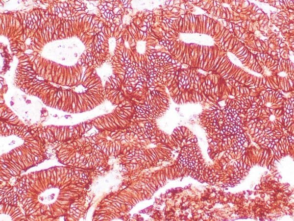 Immunohistochemistry (IHC) : Human colon adenocarcinoma stained with EP-CAM antibody using peroxidase-conjugate and DAB chromogen. Note the membranous staining of tumor cells.