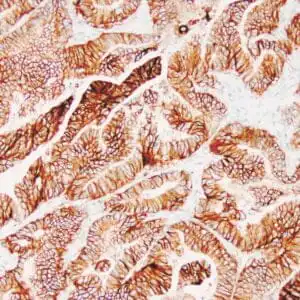 Immunohistochemistry (IHC) : Human colon adenocarcinoma stained with Ber-EP4 antibody using peroxidase-conjugate and DAB chromogen. Note the membranous staining of tumor cells