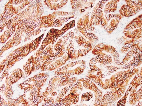 Immunohistochemistry (IHC) : Human colon adenocarcinoma stained with Ber-EP4 antibody using peroxidase-conjugate and DAB chromogen. Note the membranous staining of tumor cells