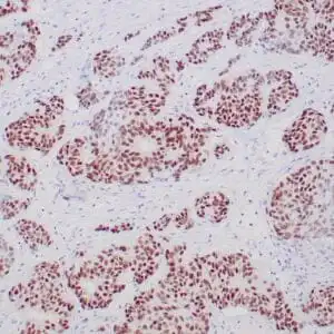 Immunohistochemistry (IHC) : Formalin-fixed, paraffin-embedded breast carcinoma stained with ZR147 antibody using peroxidase-conjugate and DAB chromogen. Note nuclear staining of tumor cells