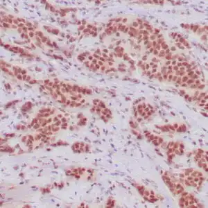 Immunohistochemistry (IHC) : Human breast adenocarcinoma stained with anti-ER antibody using peroxidase-conjugate and DAB chromogen. Note the strong nuclear staining of tumor cells.