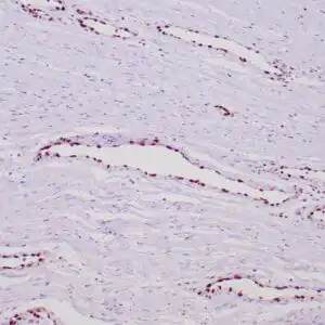 Immunohistochemistry (IHC) : Stained with anti-ERG using peroxidase-conjugate and DAB chromogen. Note nuclear staining of vascular endothelial cells.