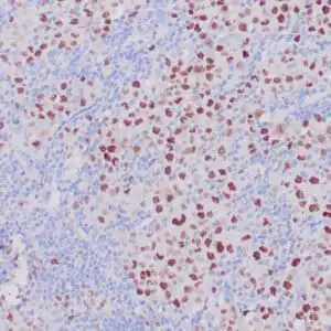 Immunohistochemistry (IHC) : Human breast ductal carcinoma stained with anti-EZH2 antibody using peroxidase-conjugate and DAB chromogen. Note nuclear staining of carcinoma cells.