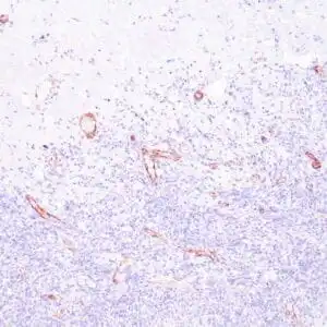 Immunohistochemistry (IHC) : Human tonsil stained with anti-Factor VIII antibody using peroxidase-conjugate and DAB chromogen. Note the cytoplasmic staining of endothelial cells.