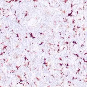 Immunohistochemistry (IHC) : Human neuroblastoma stained with anti-Factor XIIIa antibody using peroxidase-conjugate and DAB chromogen. Note the cytoplasmic staining of fibroblasts and macrophages.