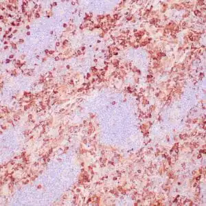 Immunohistochemistry (IHC) : Human Hodgkin lymphoma stained with anti-Fascin antibody using peroxidase-conjugate and DAB chromogen. Note the cytoplasmic staining of Hodgkin’s cells.