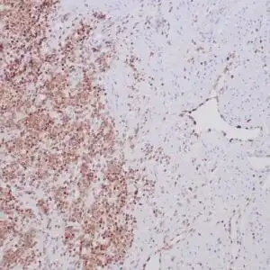 Immunohistochemistry (IHC) : Formalin-fixed, paraffin-embedded human Ewing’s sarcoma stained with anti-FLI-1 antibody using peroxidase-conjugate and DAB chromogen. Note nuclear staining of tumor cells and vascular endothelial cells