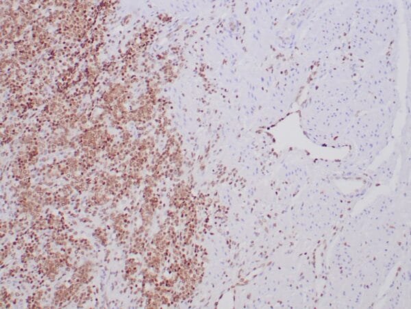 Immunohistochemistry (IHC) : Formalin-fixed, paraffin-embedded human Ewing’s sarcoma stained with anti-FLI-1 antibody using peroxidase-conjugate and DAB chromogen. Note nuclear staining of tumor cells and vascular endothelial cells