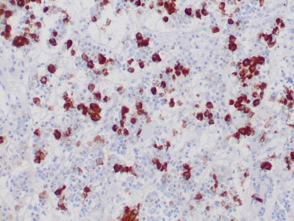 Immunohistochemistry (IHC) : Formalin-fixed, paraffin-embedded human normal pituitary stained with anti-FSH antibody using peroxidase-conjugate and DAB chromogen. Note the cytoplasmic staining of FSH secreting cells