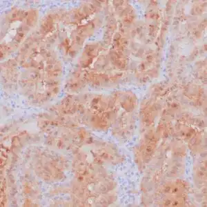 Immunohistochemistry (IHC) : Formalin-fixed, paraffin-embedded human thyroid papillary carcinoma stained with anti-galectin-3 antibody using peroxidase-conjugate and DAB chromogen. Note the nuclear and cytoplasmic staining of tumor cells