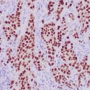 Immunohistochemistry (IHC) : Formalin-fixed, paraffin-embedded human breast ductal carcinoma stained with anti-GATA3 antibody using peroxidase-conjugate and DAB chromogen. Note nuclear staining of tumor cells