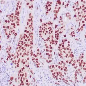 Immunohistochemistry (IHC) : Human breast carcinoma stained with anti-GATA3 antibody using peroxidase-conjugate and DAB chromogen. Note nuclear staining of tumor cells.