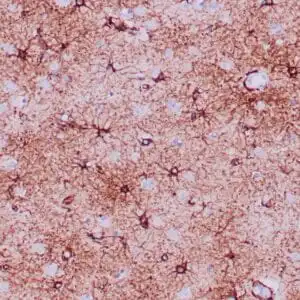 Immunohistochemistry (IHC) : Formalin-fixed, paraffin-embedded human brain stained with anti-GFAP antibody using peroxidase-conjugate and DAB chromogen. Note positive staining of astrocytic processes
