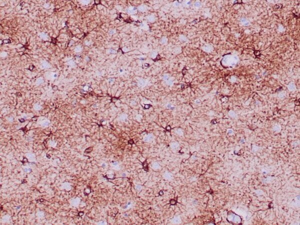 Immunohistochemistry (IHC) : Formalin-fixed, paraffin-embedded human brain stained with anti-GFAP antibody using peroxidase-conjugate and DAB chromogen. Note positive staining of astrocytic processes