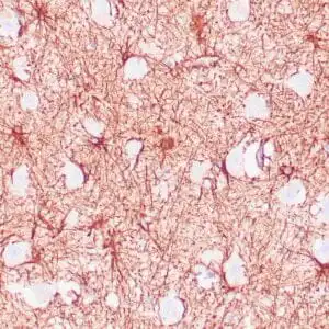 Immunohistochemistry (IHC) : Human brain stained with anti-GFAP antibody using peroxidase-conjugate and DAB chromogen. Note positive staining of astrocytic processes.