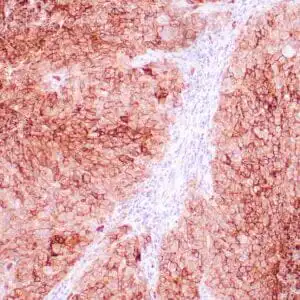 Immunohistochemistry (IHC) : Human breast carcinoma stained with anti-Glut-1 using peroxidase-conjugate and DAB chromogen. Note membranous staining of tumor cells.