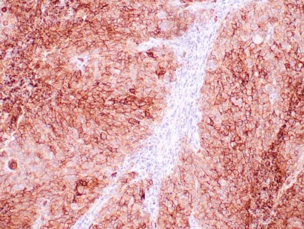 Immunohistochemistry (IHC) : Human breast carcinoma stained with anti-Glut-1 using peroxidase-conjugate and DAB chromogen. Note membranous staining of tumor cells.