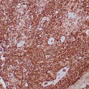 Immunohistochemistry (IHC) : Human breast carcinoma stained with anti-Glut-1 using peroxidase-conjugate and DAB chromogen. Note membranous staining of tumor cells.