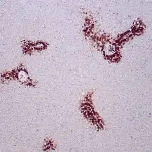 Immunohistochemistry (IHC) : Formalin-fixed, paraffin-embedded human liver stained with anti-glutamine synthetase antibody using peroxidase-conjugate and DAB chromogen. Note the cytoplasmic staining of hepatocytes around a central vein.