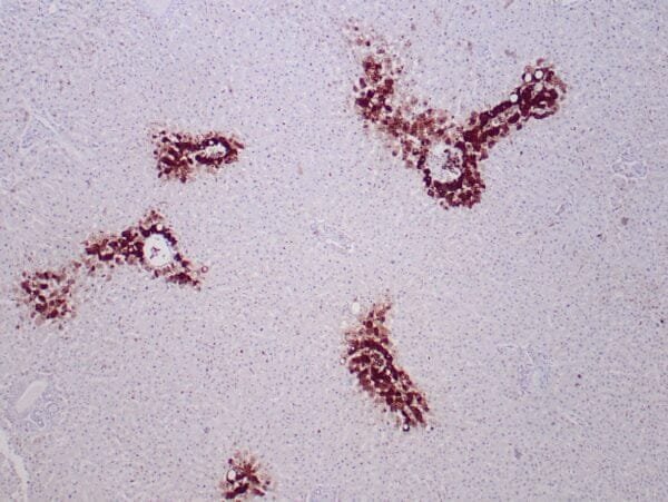 Immunohistochemistry (IHC) : Formalin-fixed, paraffin-embedded human liver stained with anti-glutamine synthetase antibody using peroxidase-conjugate and DAB chromogen. Note the cytoplasmic staining of hepatocytes around a central vein.