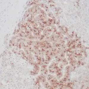 Immunohistochemistry (IHC) : Human hepatocellular carcinoma stained with anti-GPC3 antibody using peroxidase-conjugate and DAB chromogen. Note membranous and granular cytoplasmic staining of tumor cells.