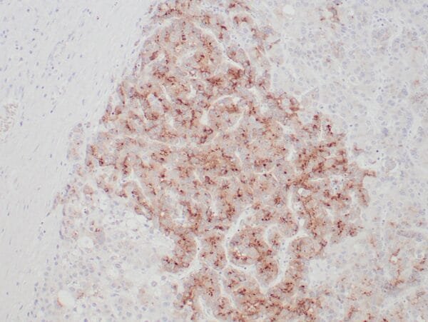 Immunohistochemistry (IHC) : Human hepatocellular carcinoma stained with anti-GPC3 antibody using peroxidase-conjugate and DAB chromogen. Note membranous and granular cytoplasmic staining of tumor cells.