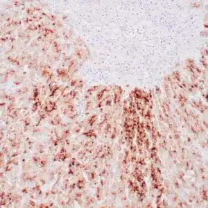 Immunohistochemistry (IHC) : Human hepatocellular carcinoma stained with anti-GPC3 antibody using peroxidase-conjugate and DAB chromogen. Note membranous and granular cytoplasmic staining of tumor cells.