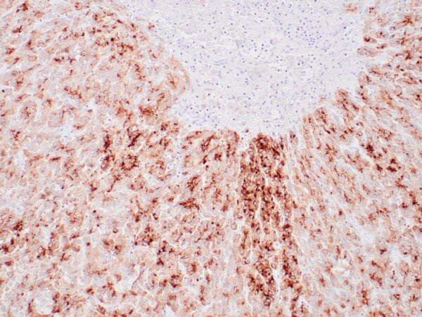 Immunohistochemistry (IHC) : Human hepatocellular carcinoma stained with anti-GPC3 antibody using peroxidase-conjugate and DAB chromogen. Note membranous and granular cytoplasmic staining of tumor cells.