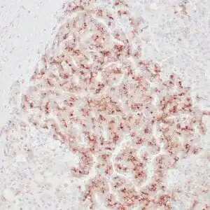 Immunohistochemistry (IHC) : Human hepatocellular carcinoma stained with anti-GPC3 antibody using peroxidase-conjugate and DAB chromogen. Note membranous and granular cytoplasmic staining of tumor cells.