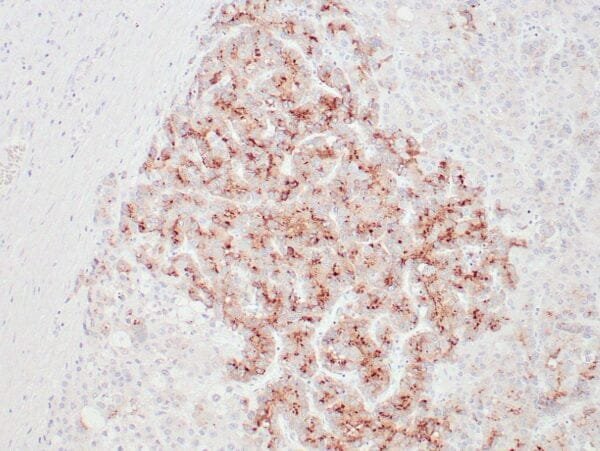 Immunohistochemistry (IHC) : Human hepatocellular carcinoma stained with anti-GPC3 antibody using peroxidase-conjugate and DAB chromogen. Note membranous and granular cytoplasmic staining of tumor cells.