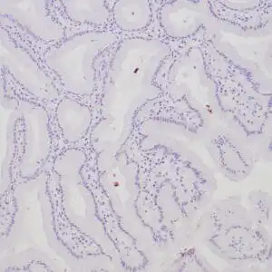 Immunohistochemistry (IHC) : Human stomach stained with anti-H. pylori antibody using peroxidase-conjugate and DAB chromogen. Note intense staining of H. Pylori organisms on the surface of gastric epithelial cells.